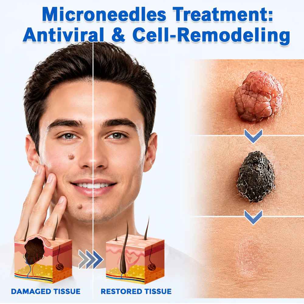 ✨Curalona® 2-in-1 Microneedle & Hydrocolloid Patch🍀 | Removes raised moles, acne, flat warts, and skin tags | Helps improve wrinkles, scars, and blemishes | Invisible patches for face and body